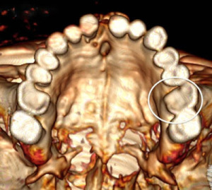 The Introduction of Grain in the Neolithic Period, marks the introduction of tooth related ailments, as exhibited in the mouth of Otzi-our well-mummified ancestor from the Neolithic Period. 